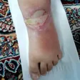 درمانگر زخم داود حسنلو