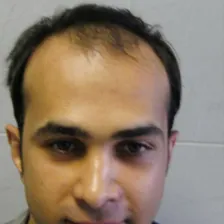 کلینیک کاشت مو و ابرو بوژان