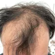 کلینیک کاشت مو سما