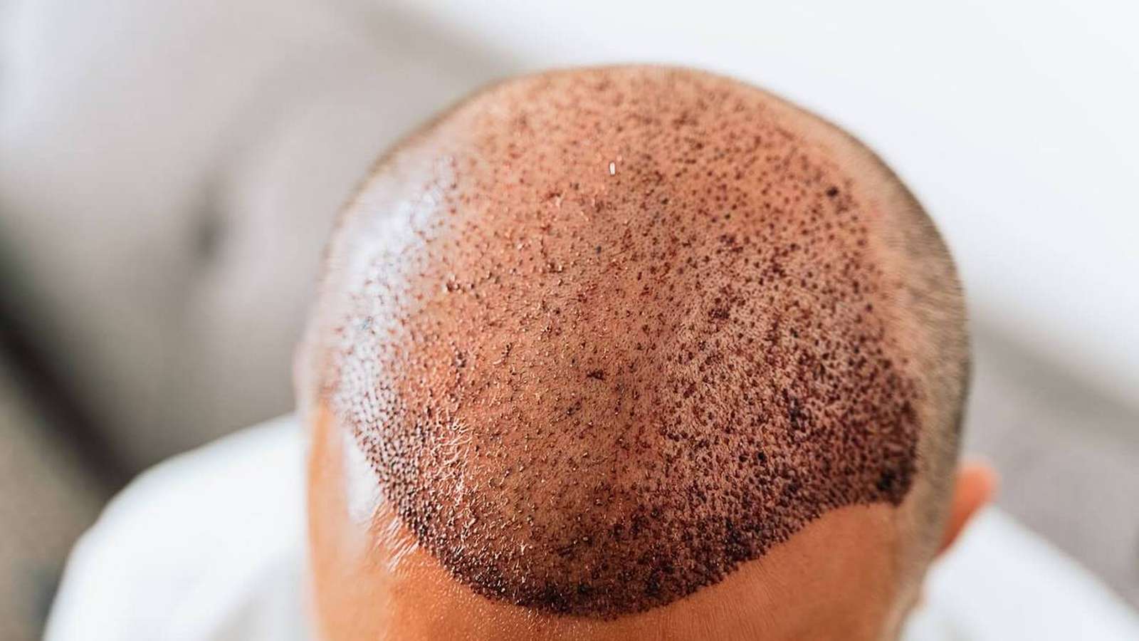 بعد از کاشت مو چه اتفاقی رخ می‌دهد؟