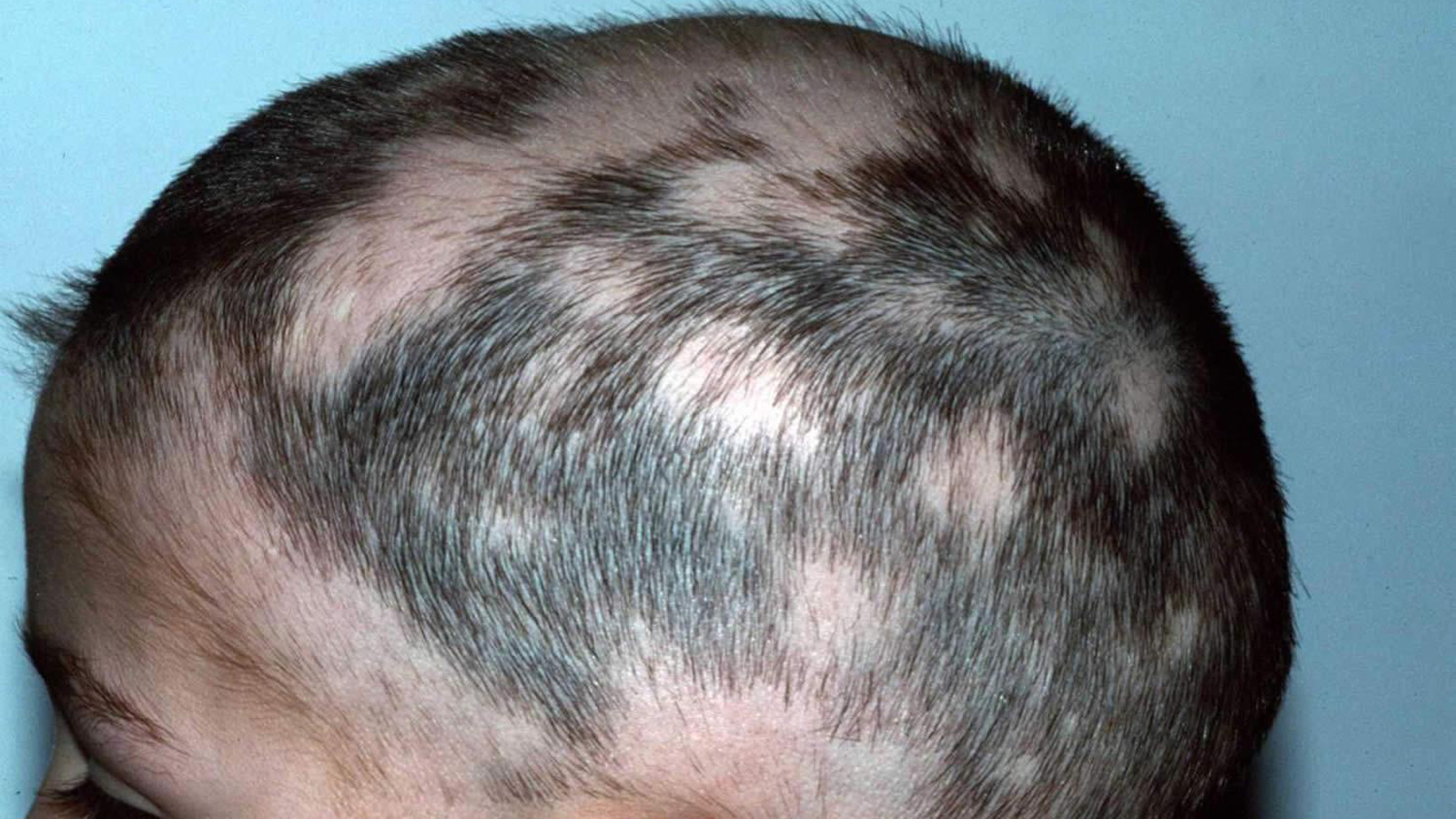 ریزش مو سکه ای