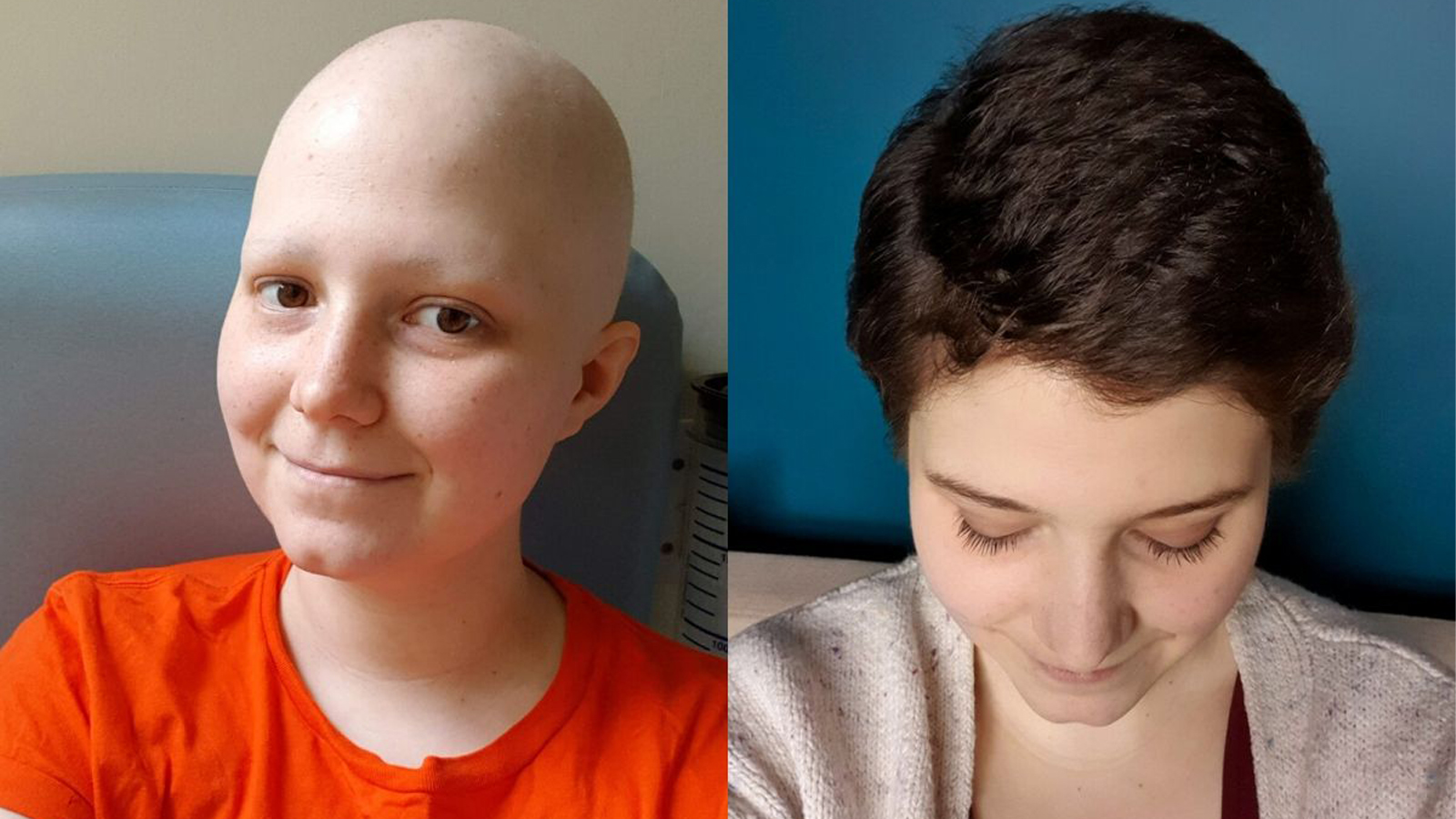 ریزش مو بعد از شیمی درمانی