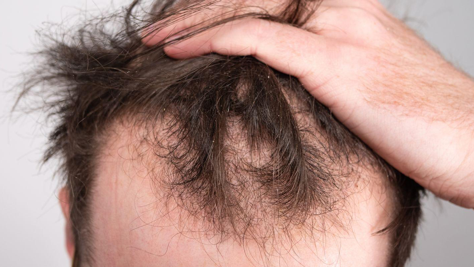 ریزش مو ارثی چیست؟