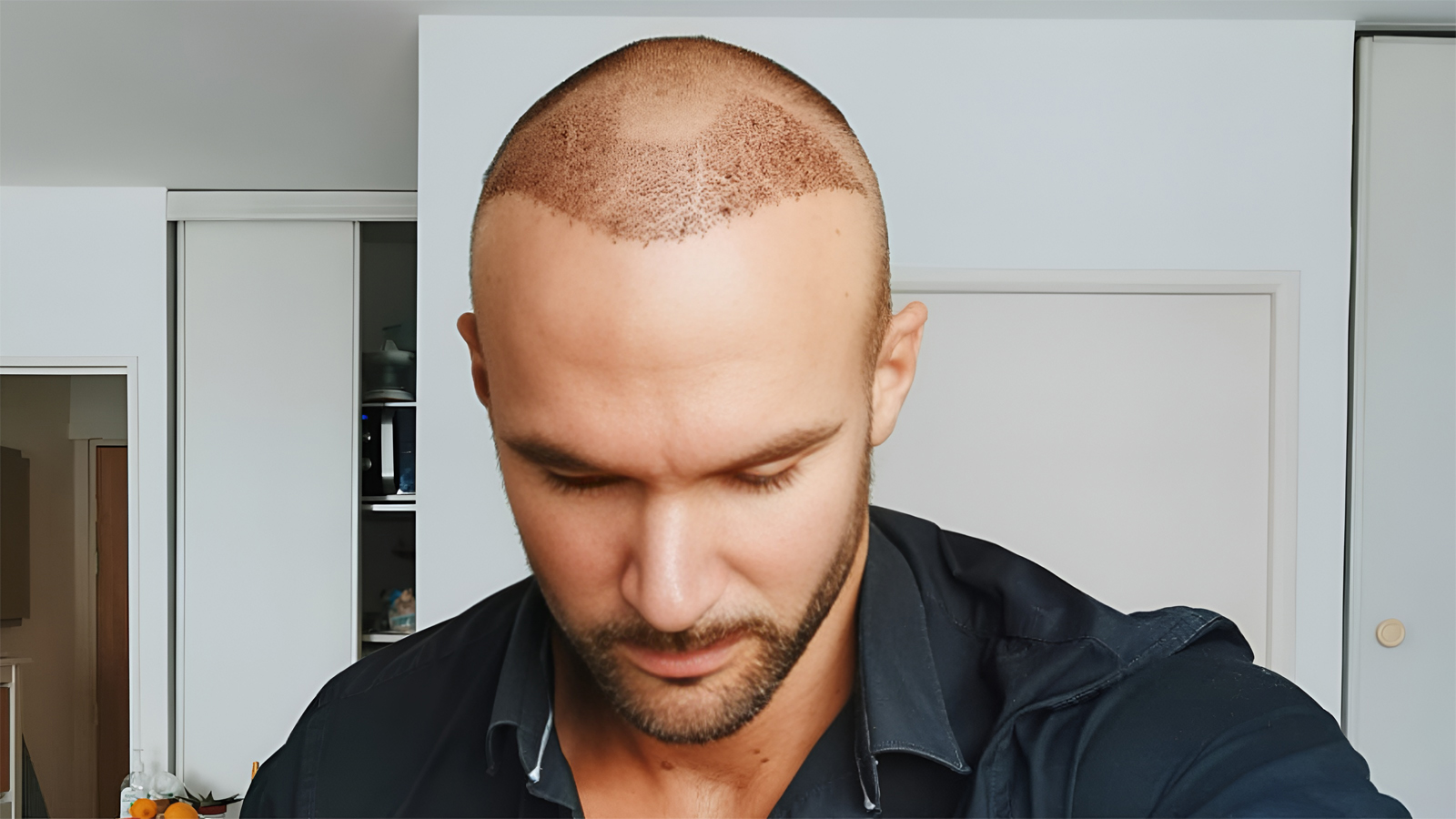 ریزش مو بعد از کاشت چیست؟