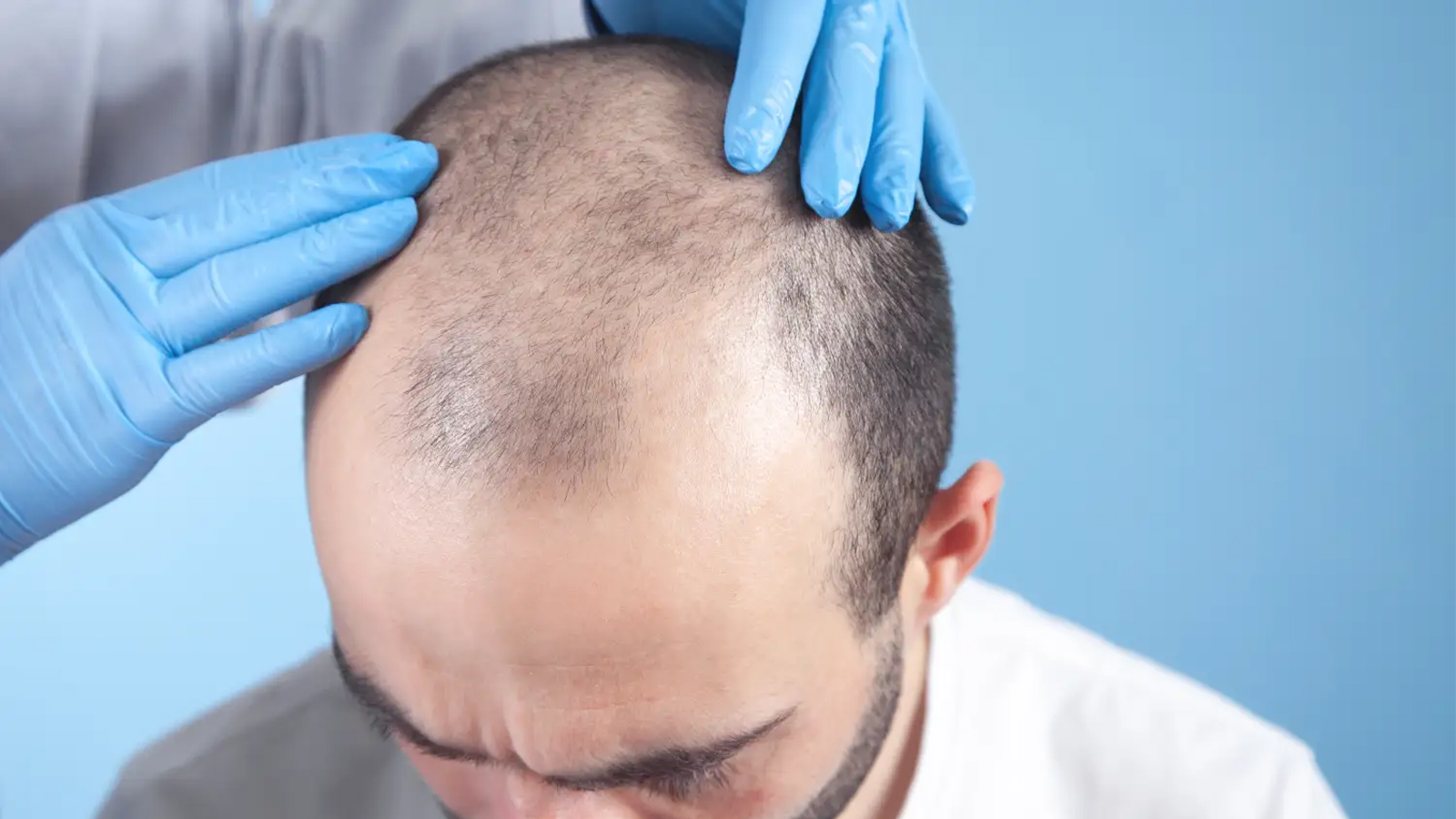 ریزش مو یکسال بعد از کاشت طبیعی است؟