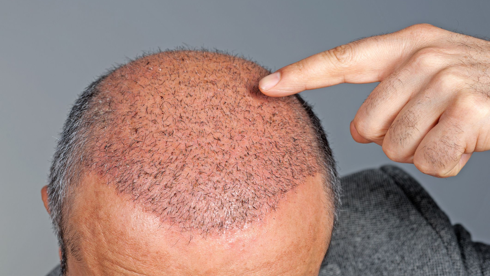 علت ریزش مو بعد از کاشت