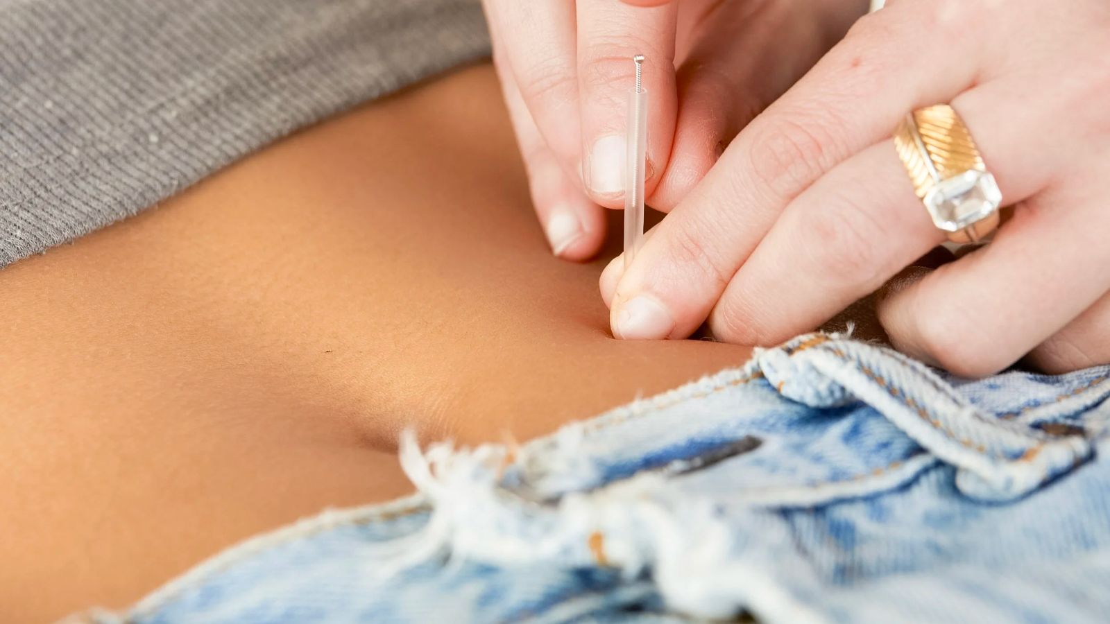 میکرونیدلینگ، روشی برای بهبود ترک پوستی بارداری