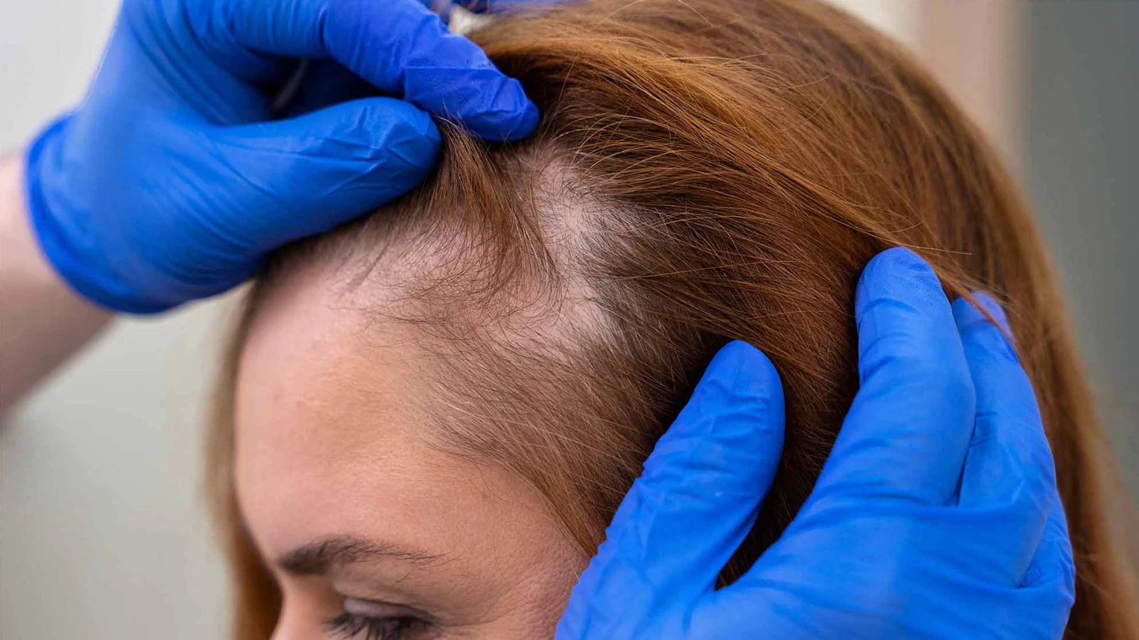 علتهای ریزش مو سکه ای