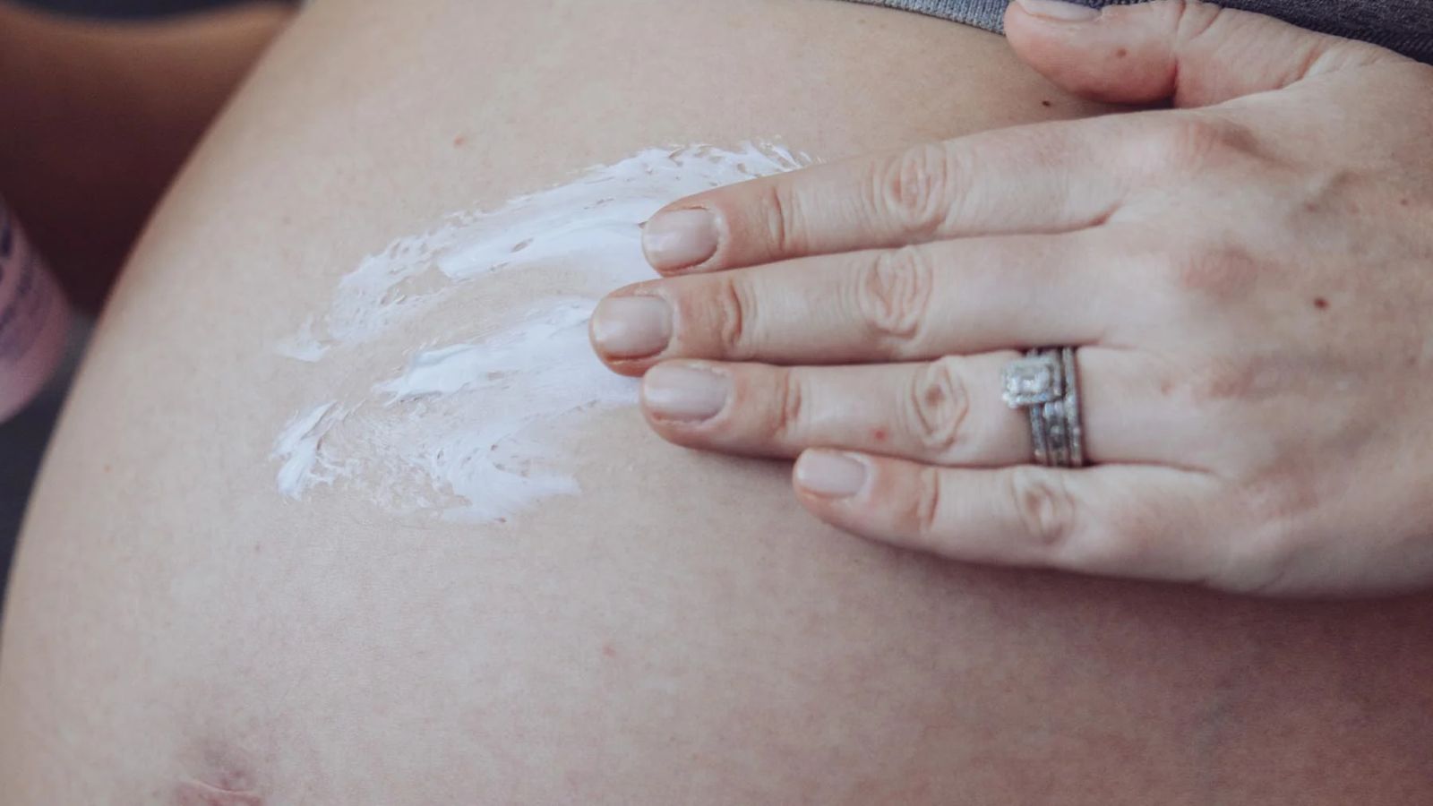 کرم برای ترکهای پوستی بارداری