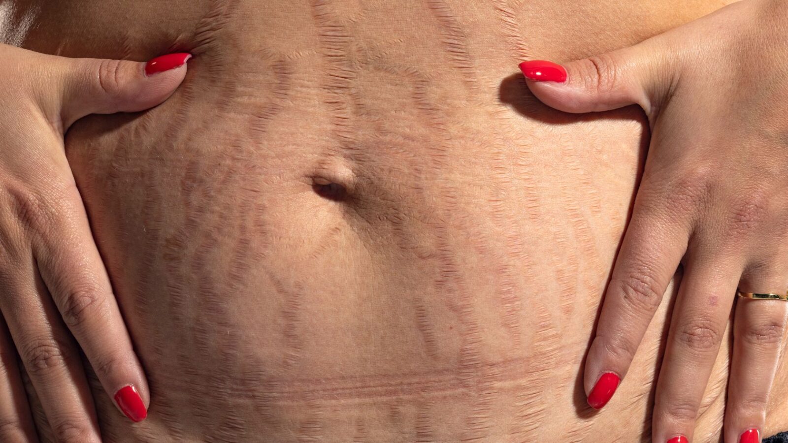 ترکهای پوستی به صورت خطوطی برجسته و به رنگ صورتی، قرمز یا بنفش