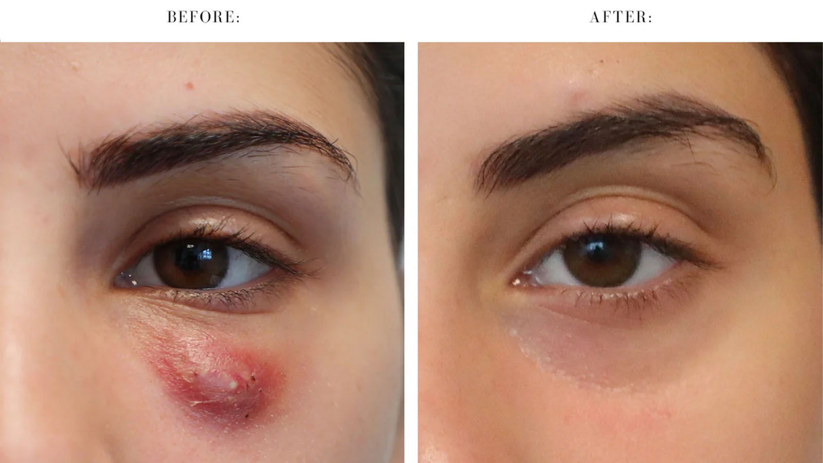 تزریق ژل زیر چشم