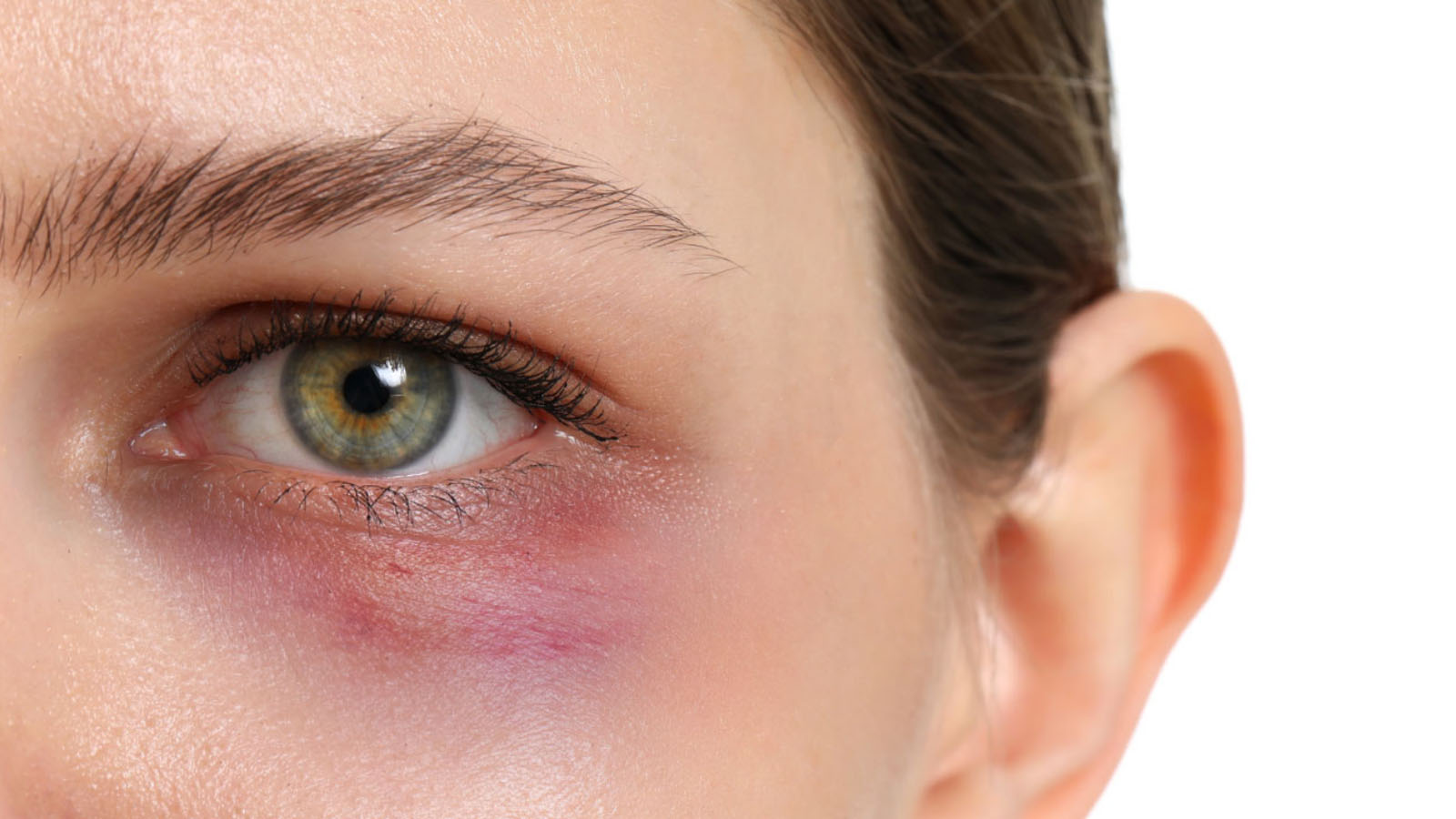 آیا فیلر زیر چشم عوارض دارد