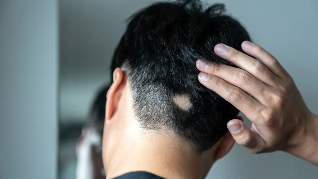 ریزش مو سکهای (آلوپسی آرهآتا)