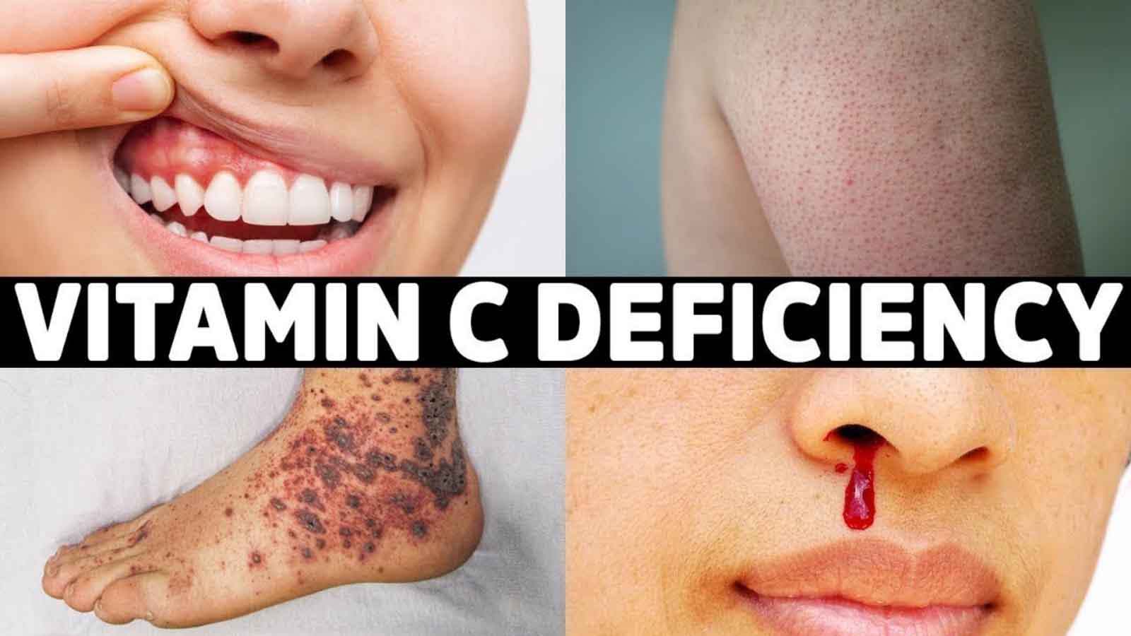 عوارض خوردن ویتامین سی در شب