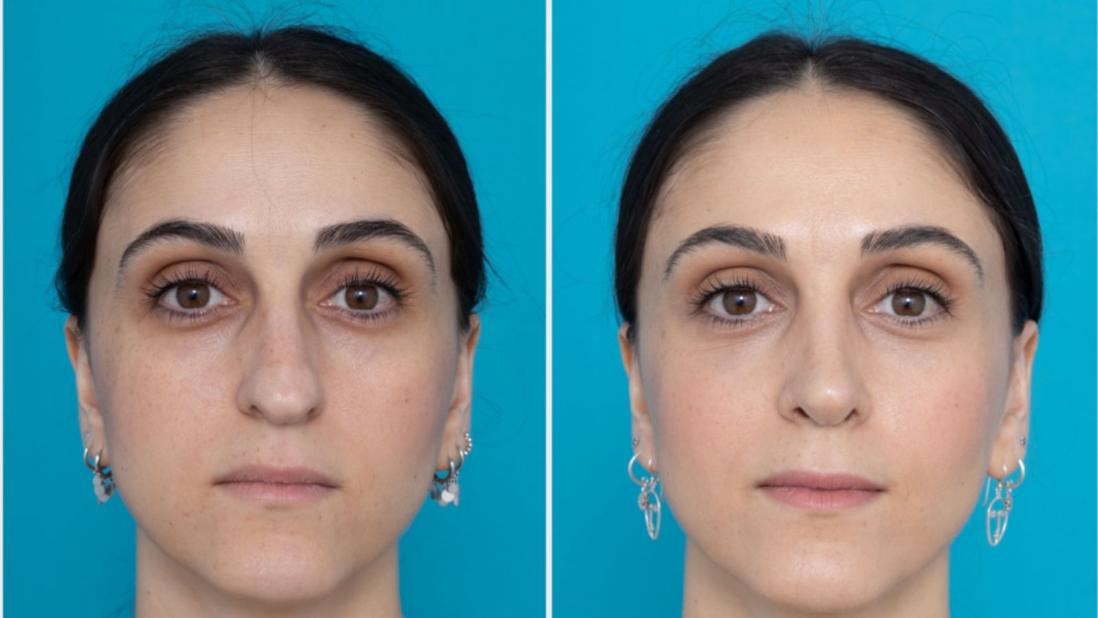 عمل بینی گوشتی سخت تره یا استخوانی  