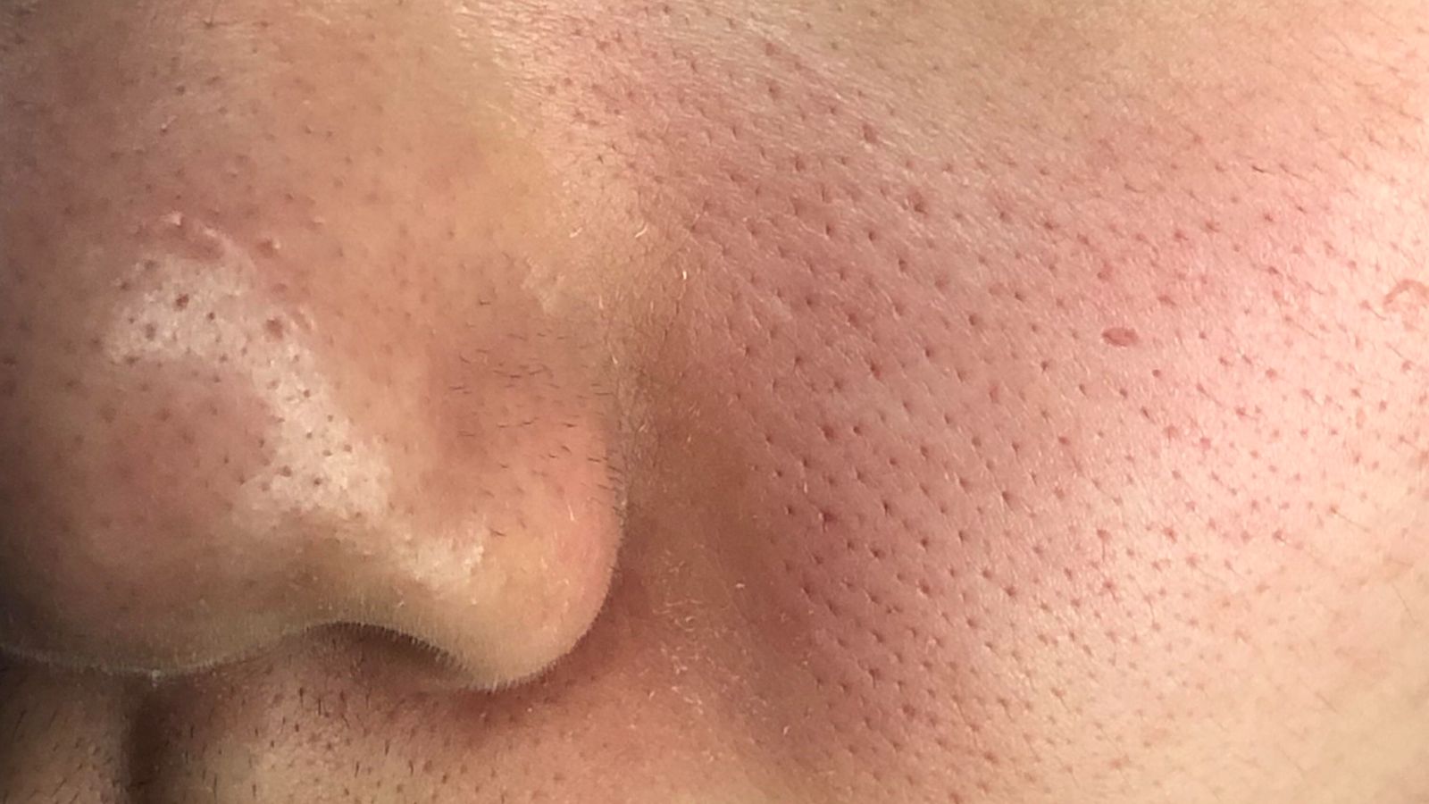 پوست مختلط یعنی چه؟