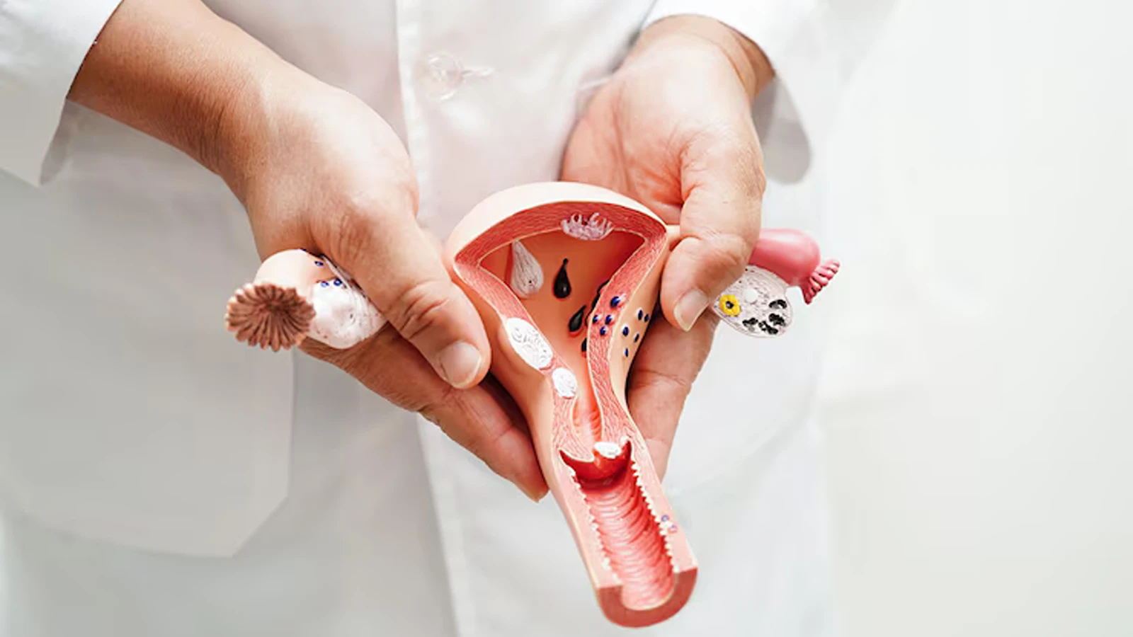 دلایل بروز فیبرم رحمی