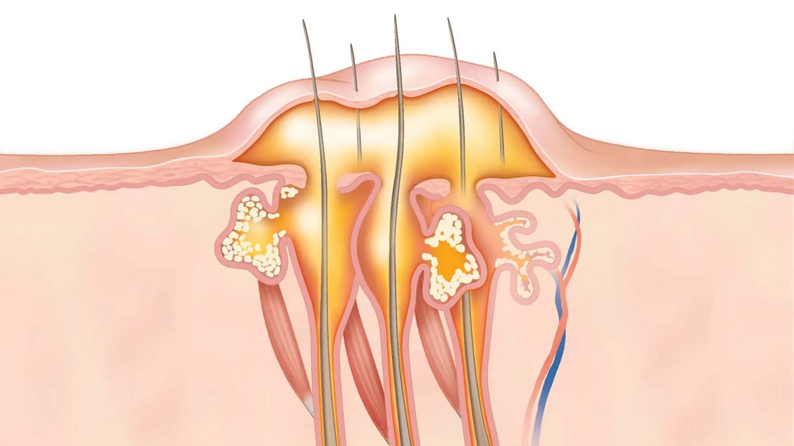 بیماری کورک پوستی