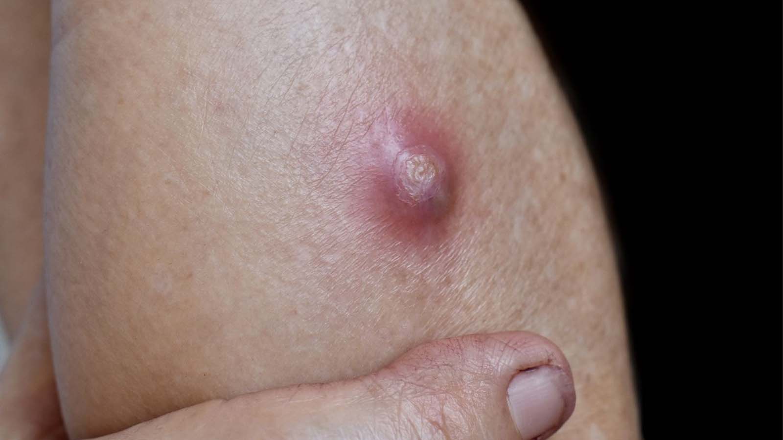 عکس کورک پوستی