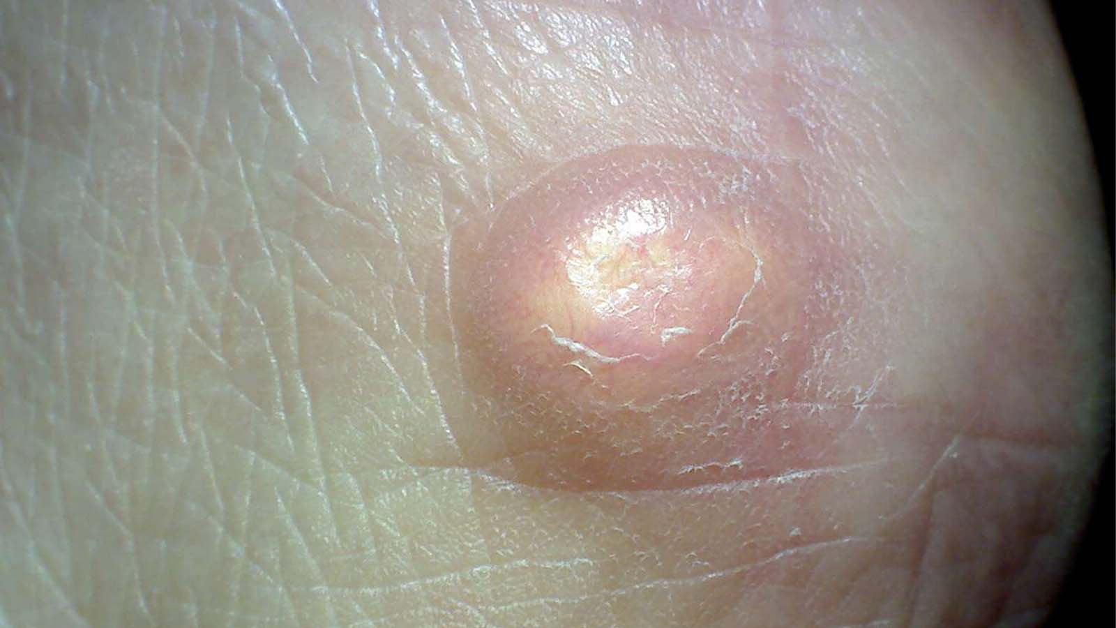 تخلیه کورک پوستی