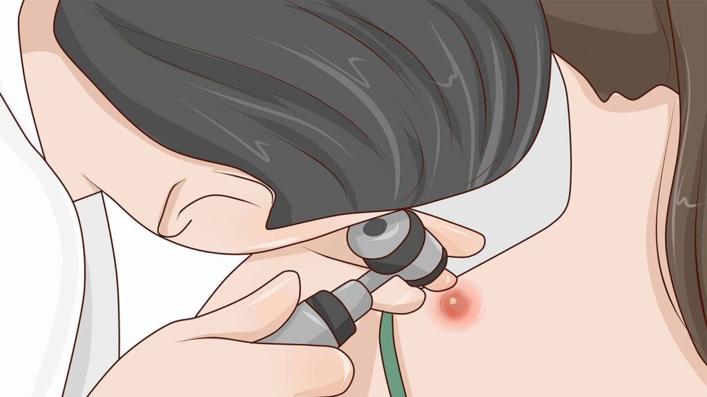 درمان کورک پوستی