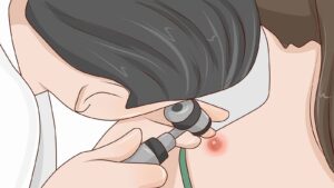 درمان کورک پوستی