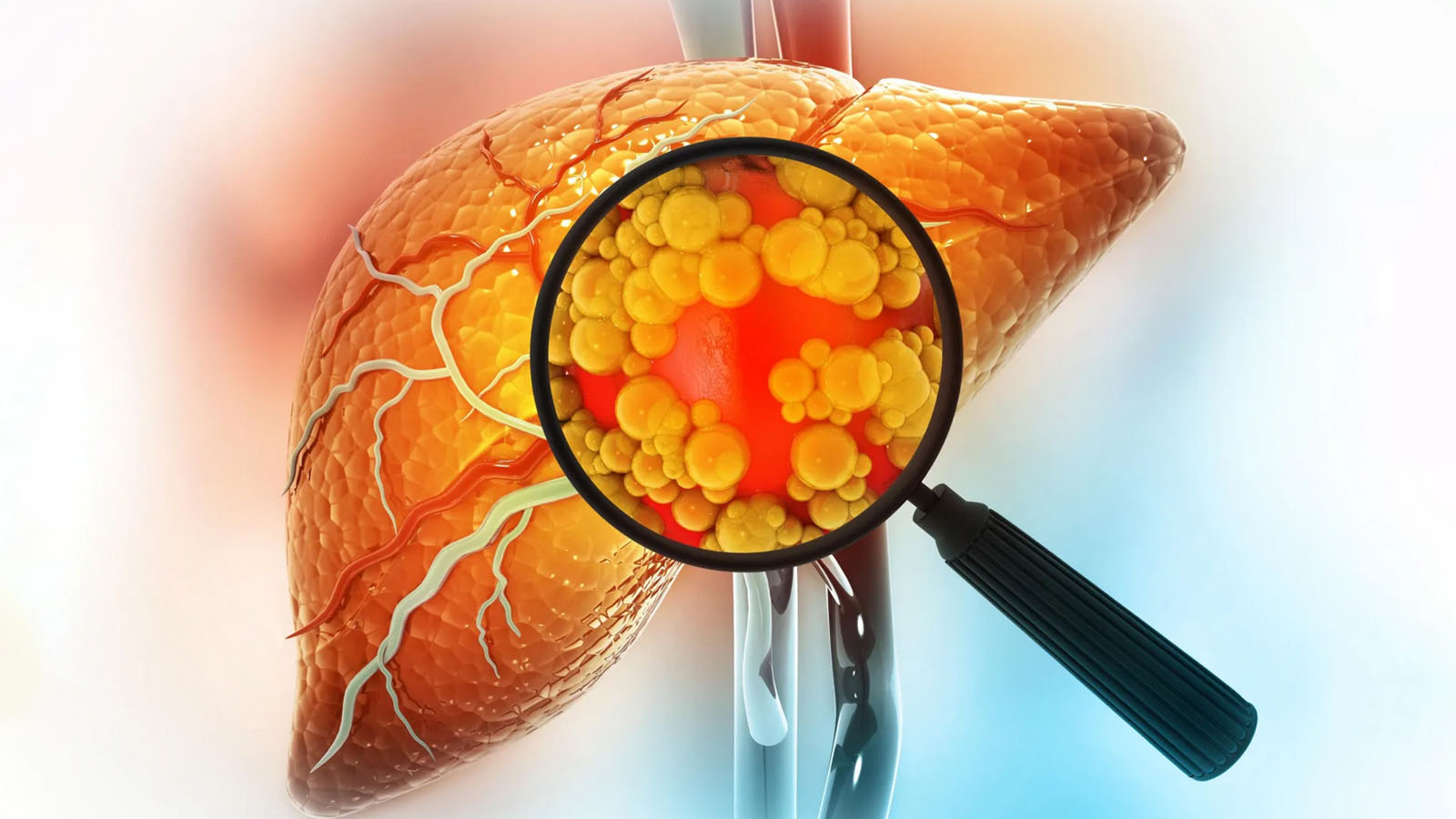 درمان قطعی کبد چرب گرید 1