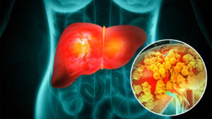 علائم کبد چرب در چهره - خطرات کبد چرب