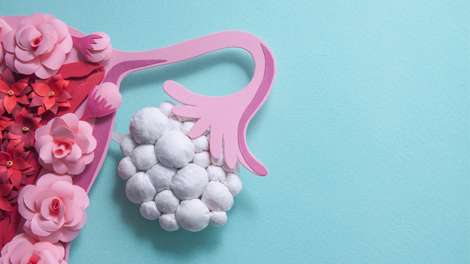 علت سندرم تخمدان پلی کیستیک