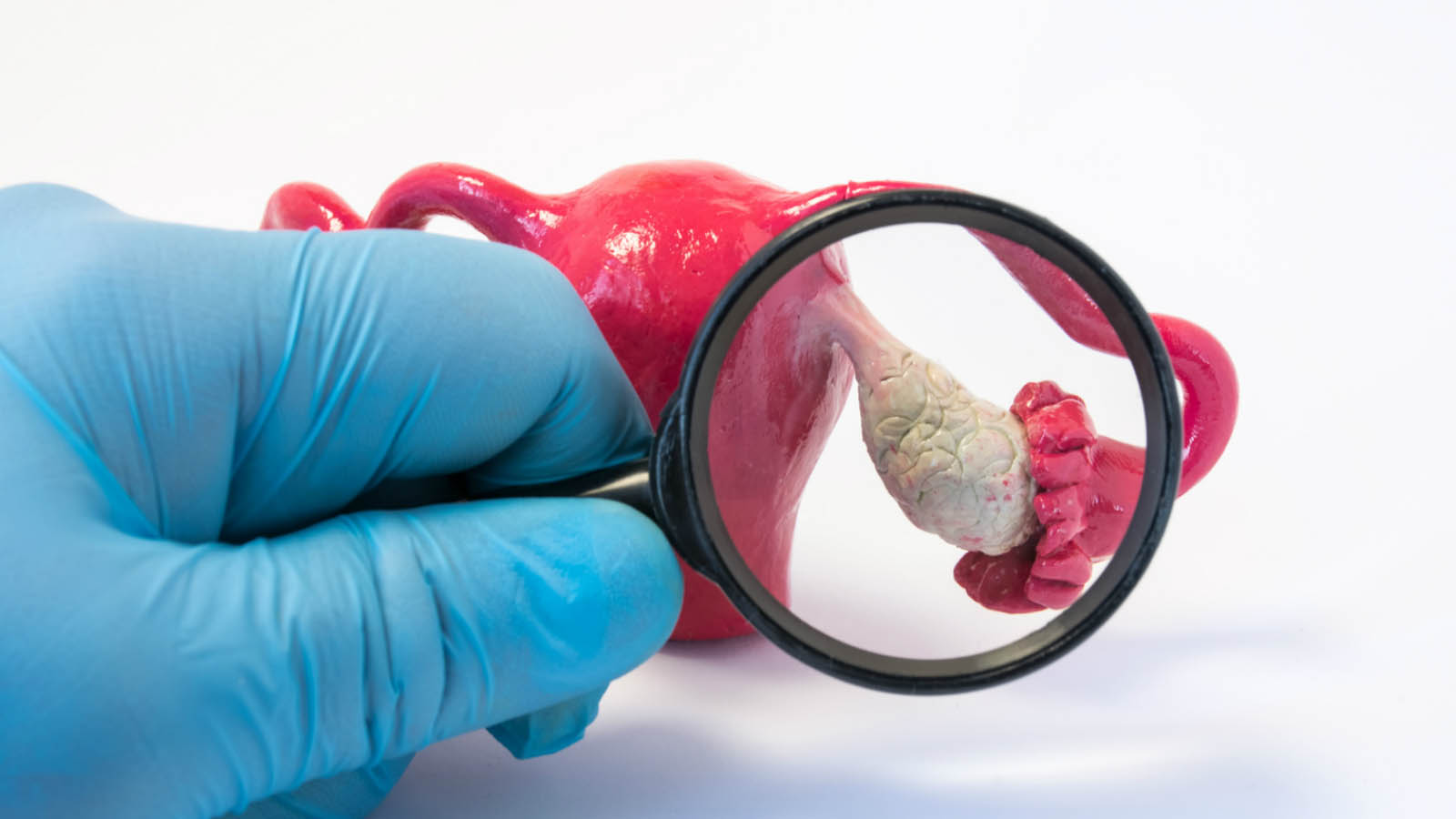 نشانه های سندرم تخمدان پلی کیستیک