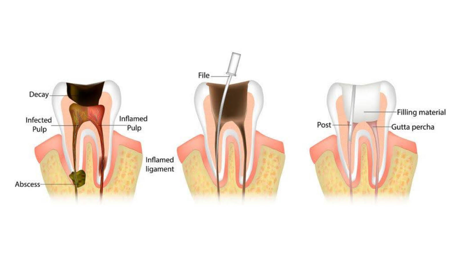 مراحل درمان ریشه چیست