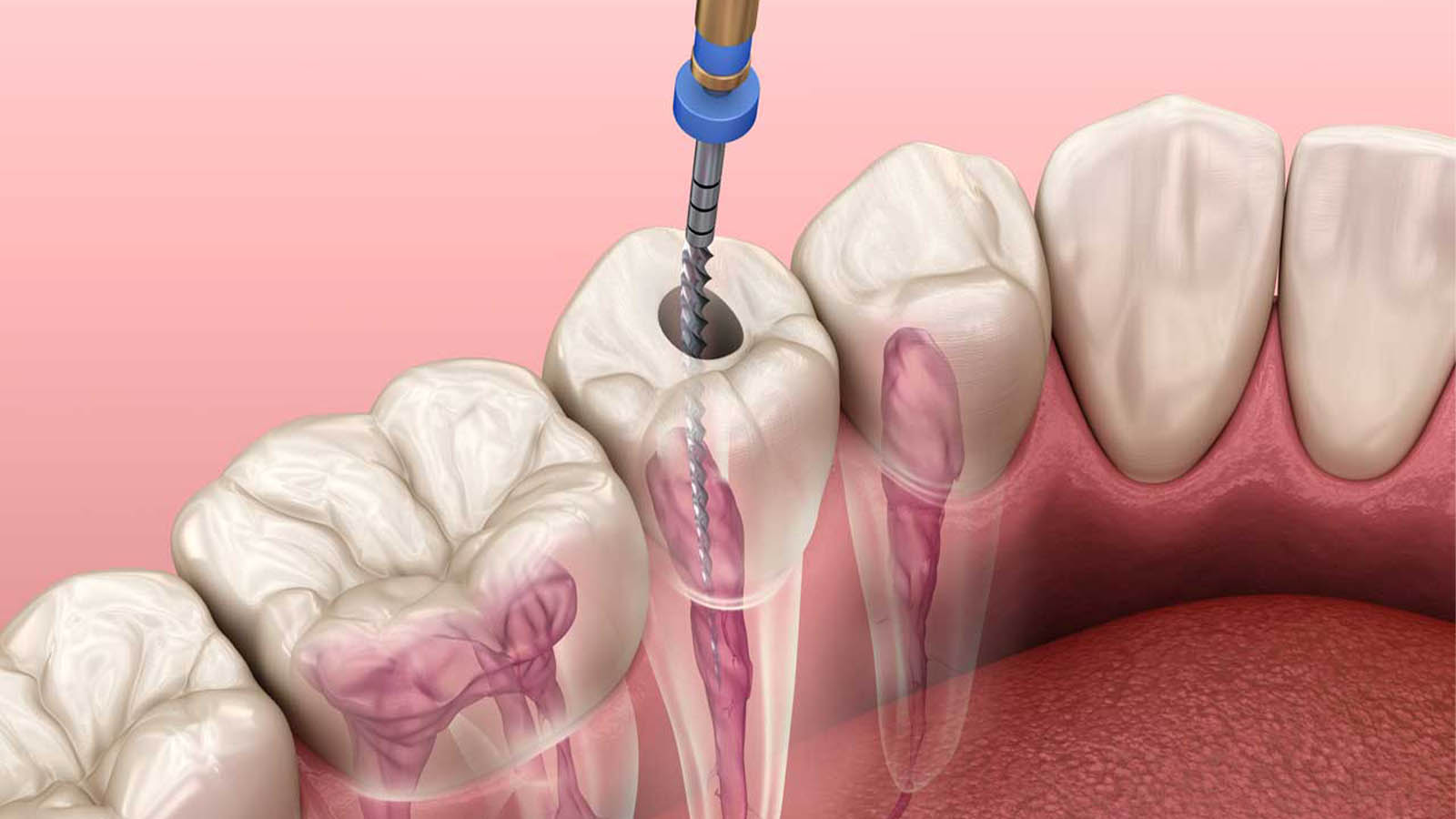 هزینه عصب کشی