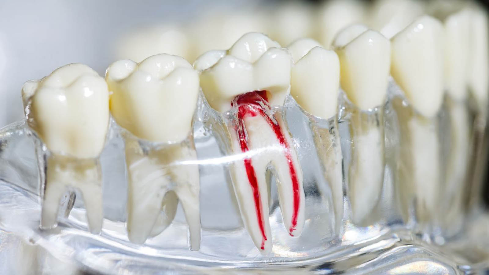 عفونت بعد از عصب کشی