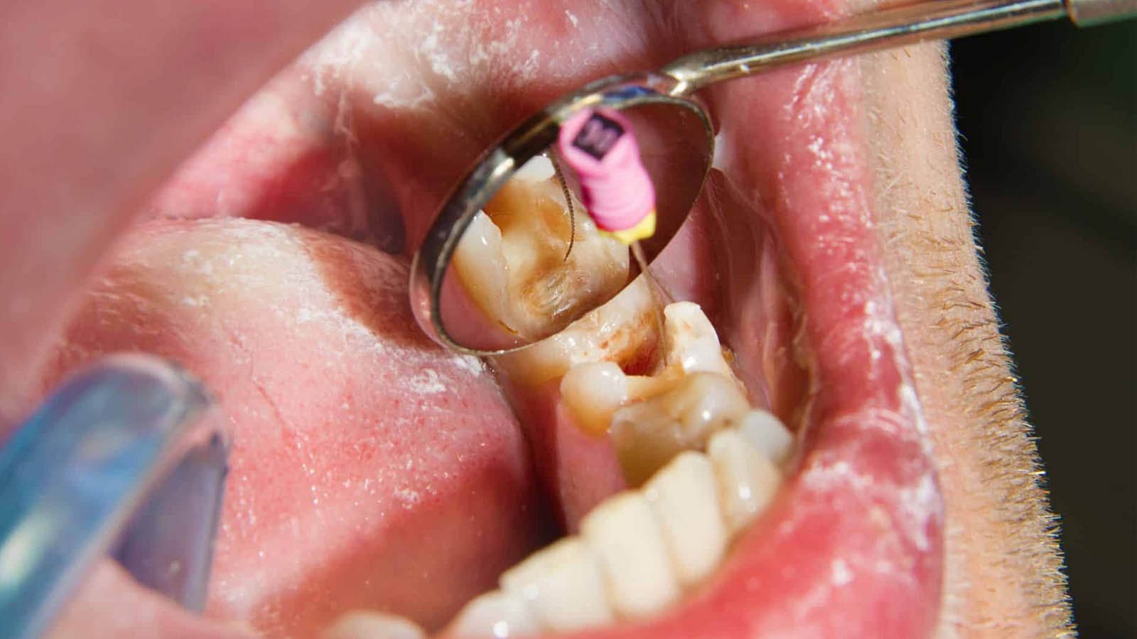 طریقه عصب کشی دندان