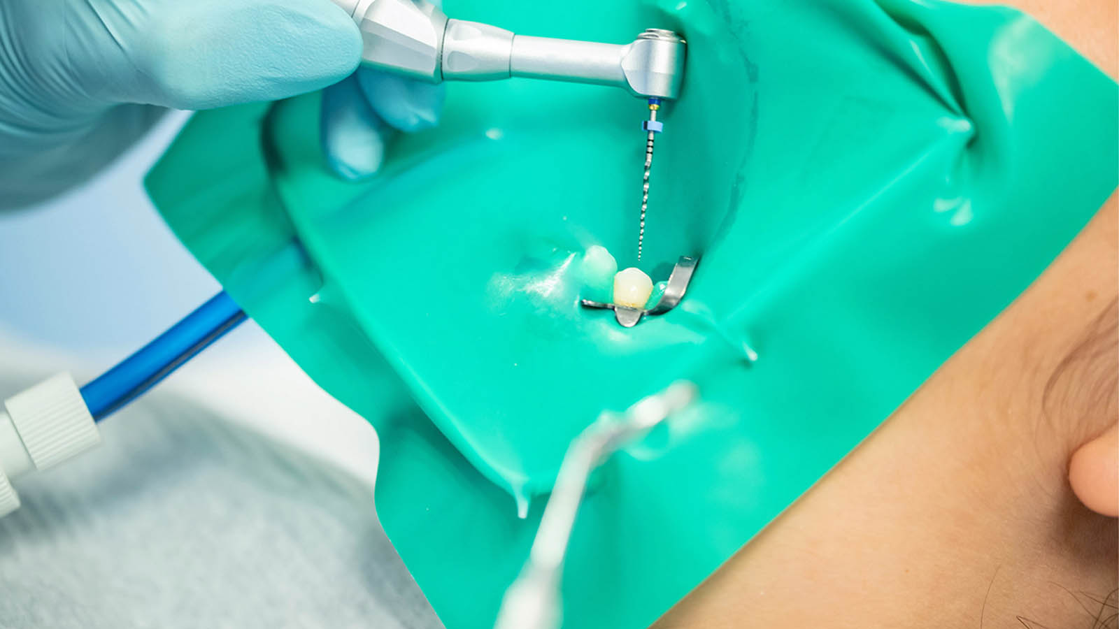 عصب کشی دندان چقدر طول میکشه