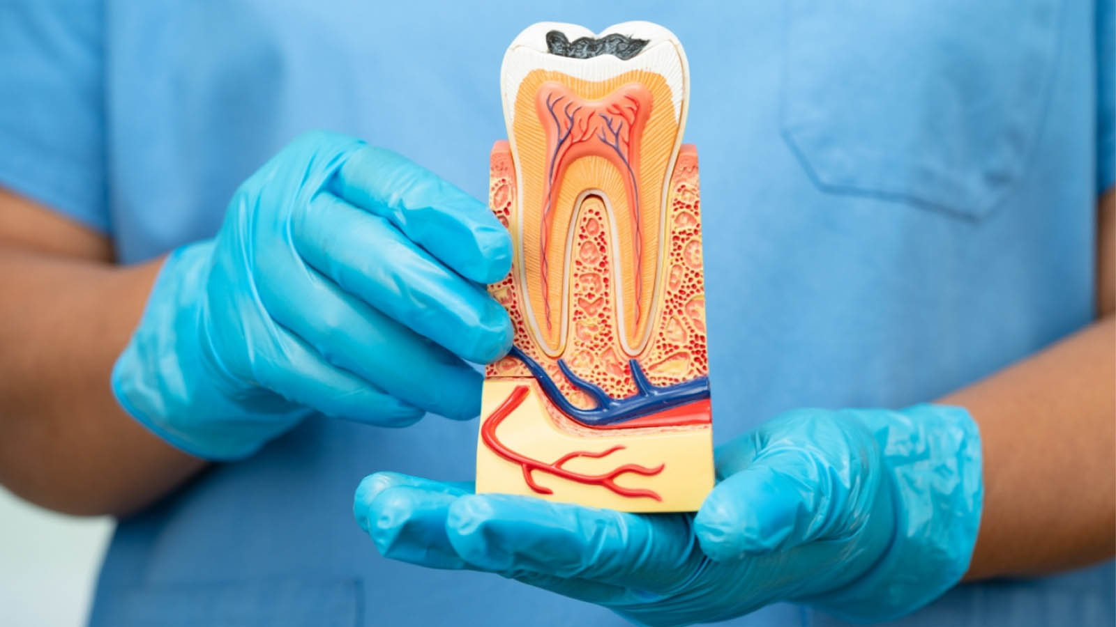 خونریزی بعد از عصب کشی دندان