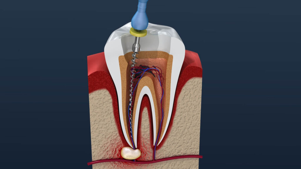 آیا عصب کشی درد دارد
