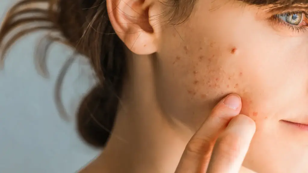 جوش (آکنه) هورمونی