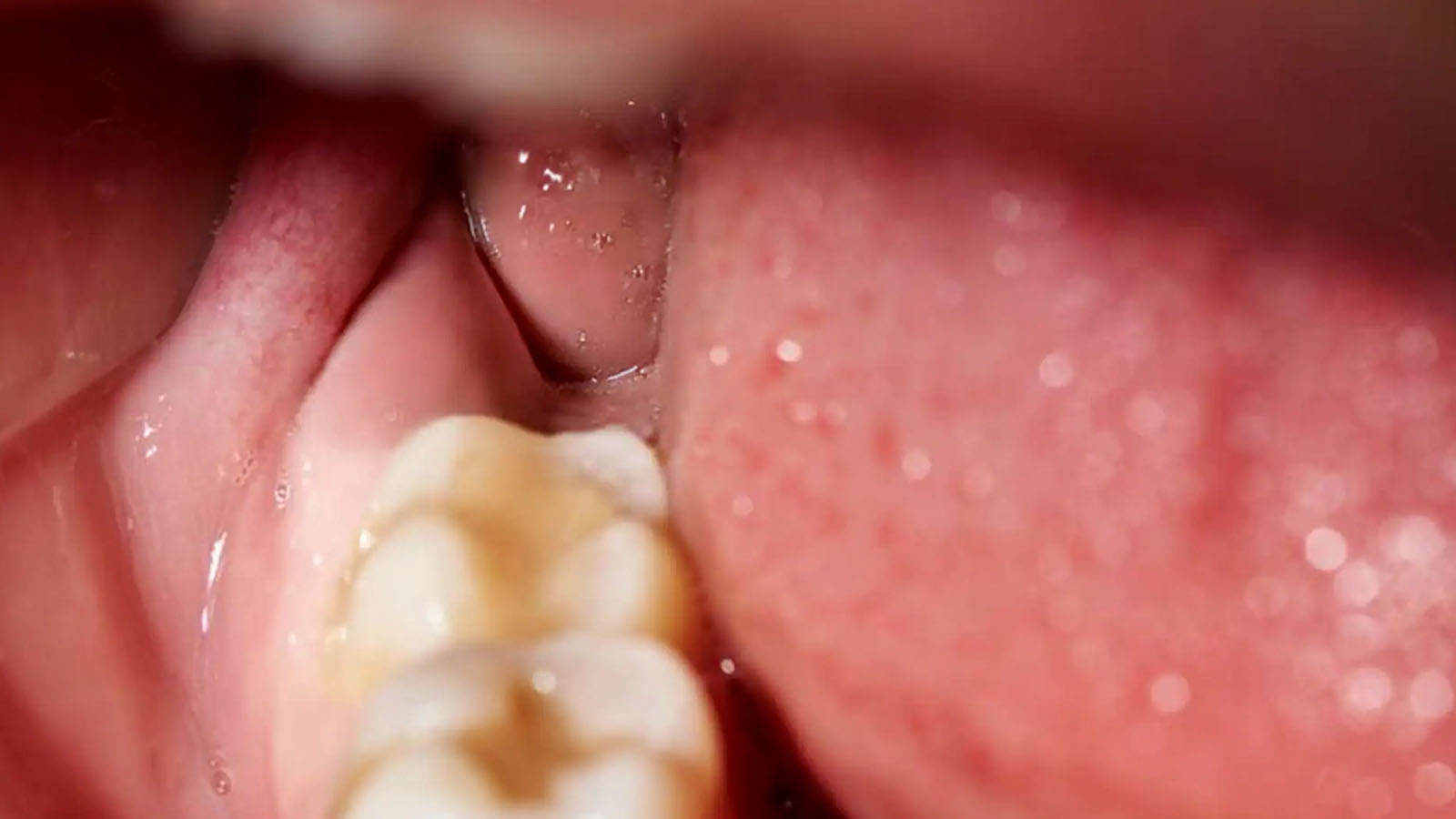 غذا بعد از کشیدن دندان