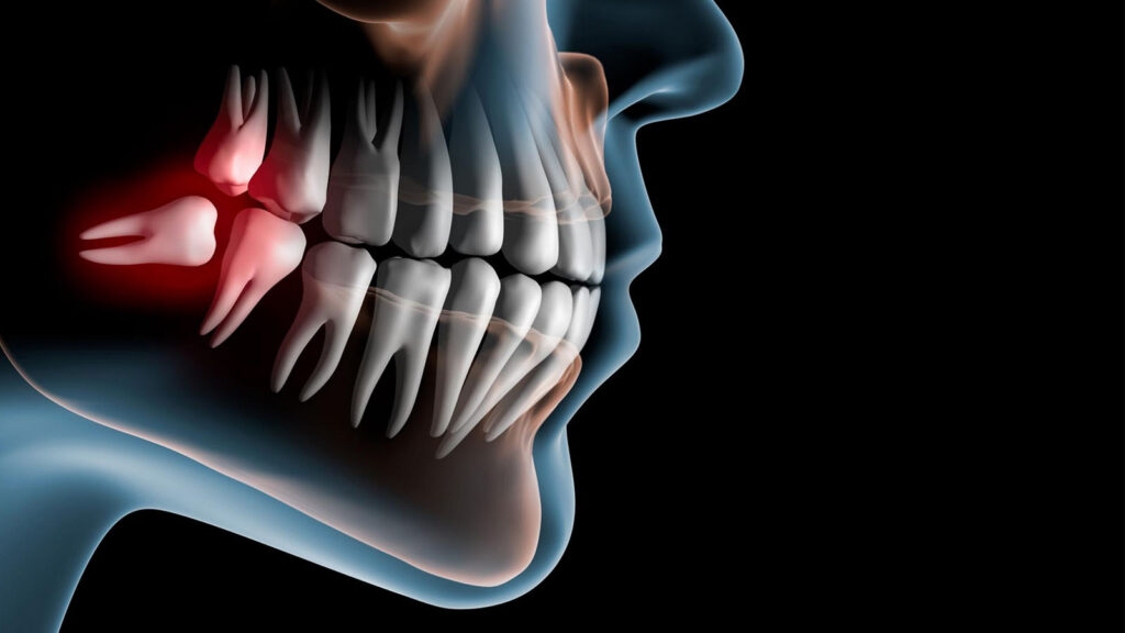 علائم نهفتگی دندان عقل