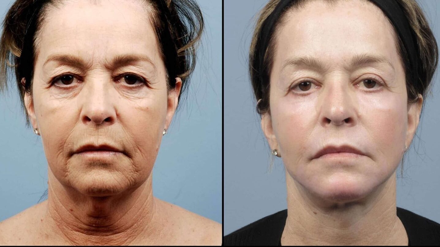 قبل و بعد لیزر فرکشنال