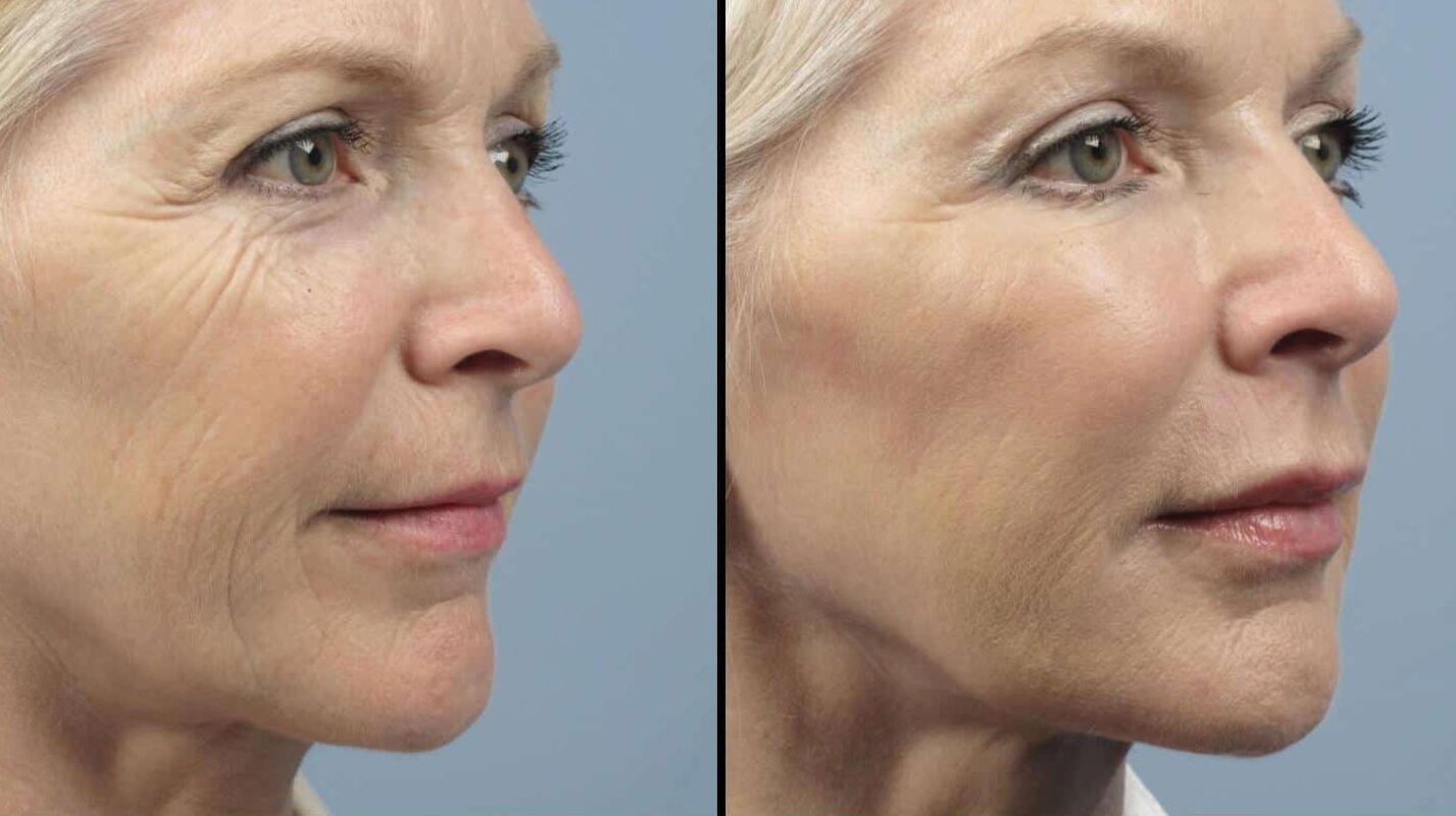 میزان تاثیر لیزر در جوان سازی