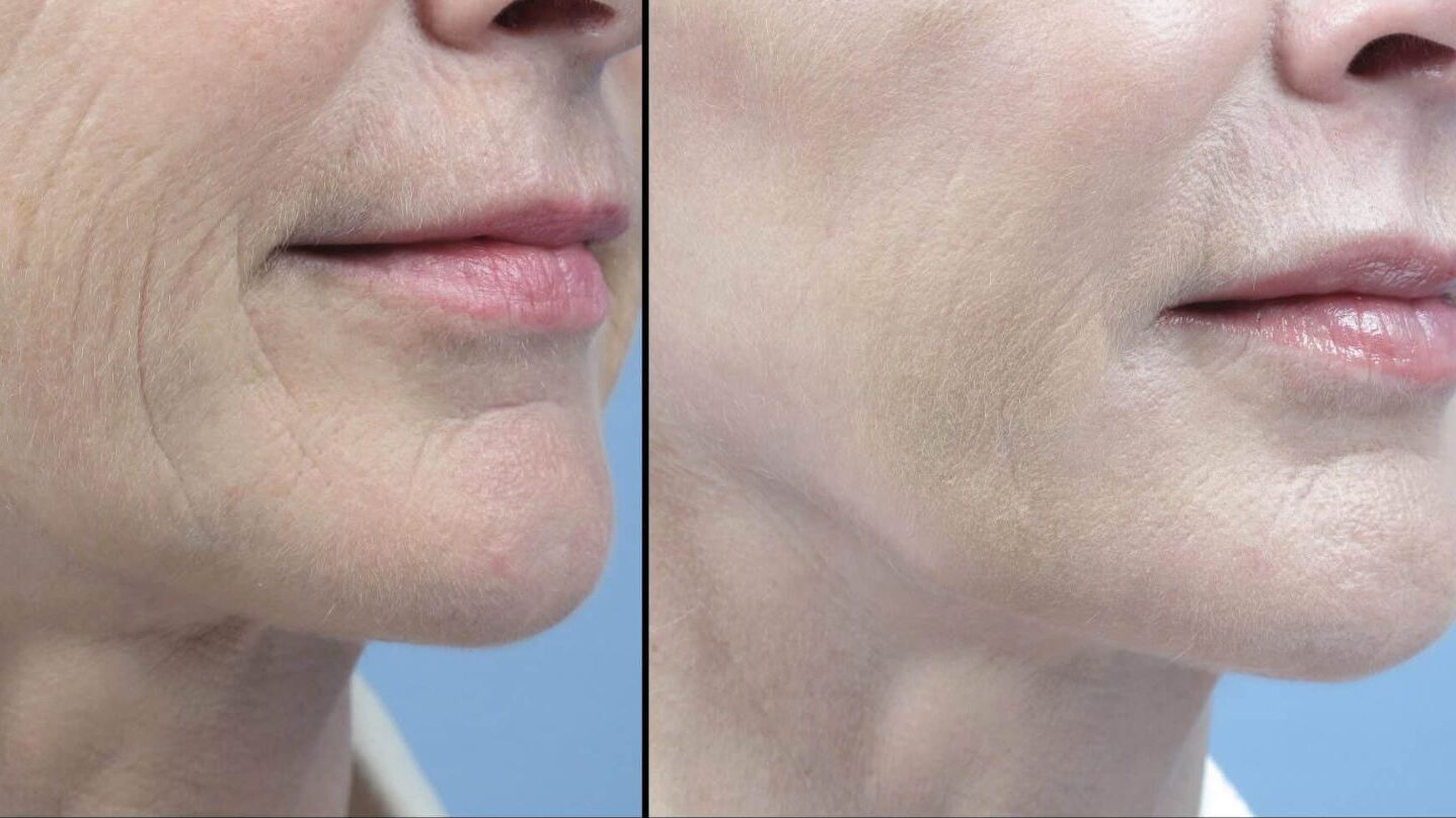 لیزر co2 فرکشنال برای چین و چروک