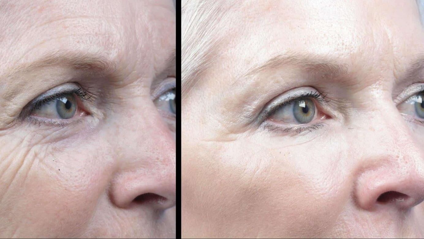 مقایسه نتیجه لیزر co2