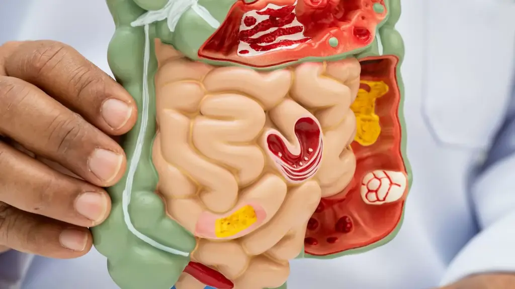 انسداد روده؛ نشانه‌ها، درمان خانگی و زمان مراجعه به پزشک