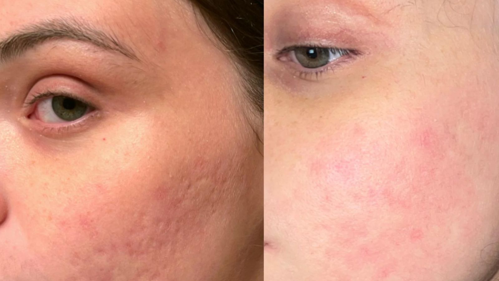 لیزر CO2 برای جای جوش