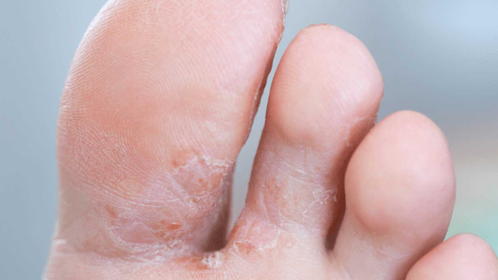 تفاوت قارچ پوستی و اگزما