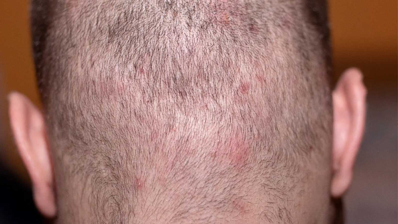 چگونه از سرایت قارچ جلوگیری کنیم