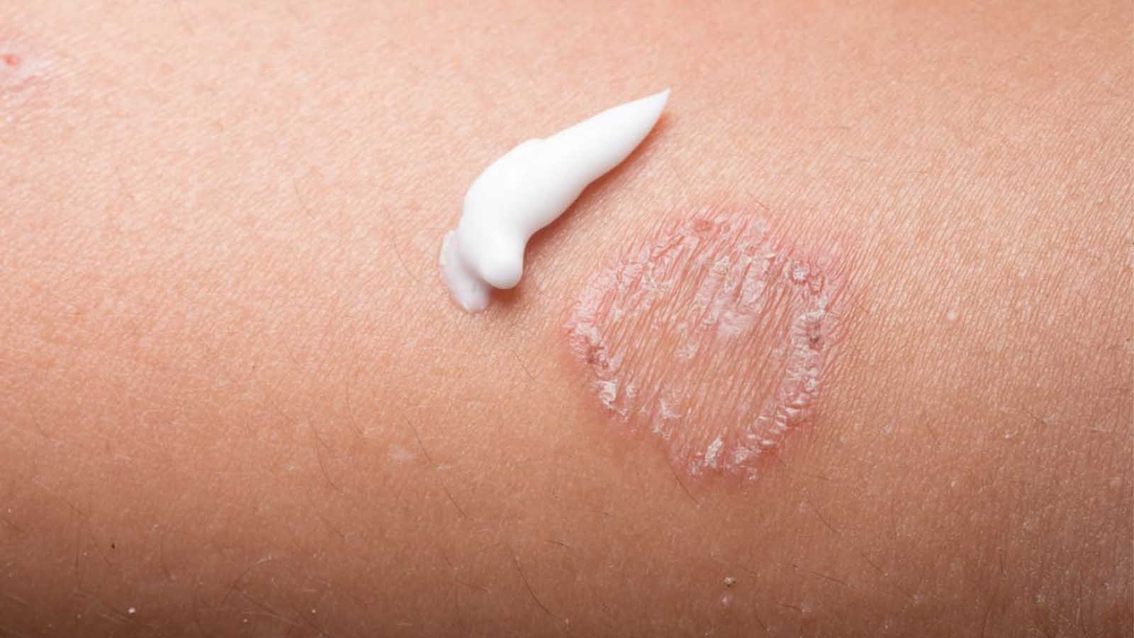 مدت زمان درمان قارچ پوستی