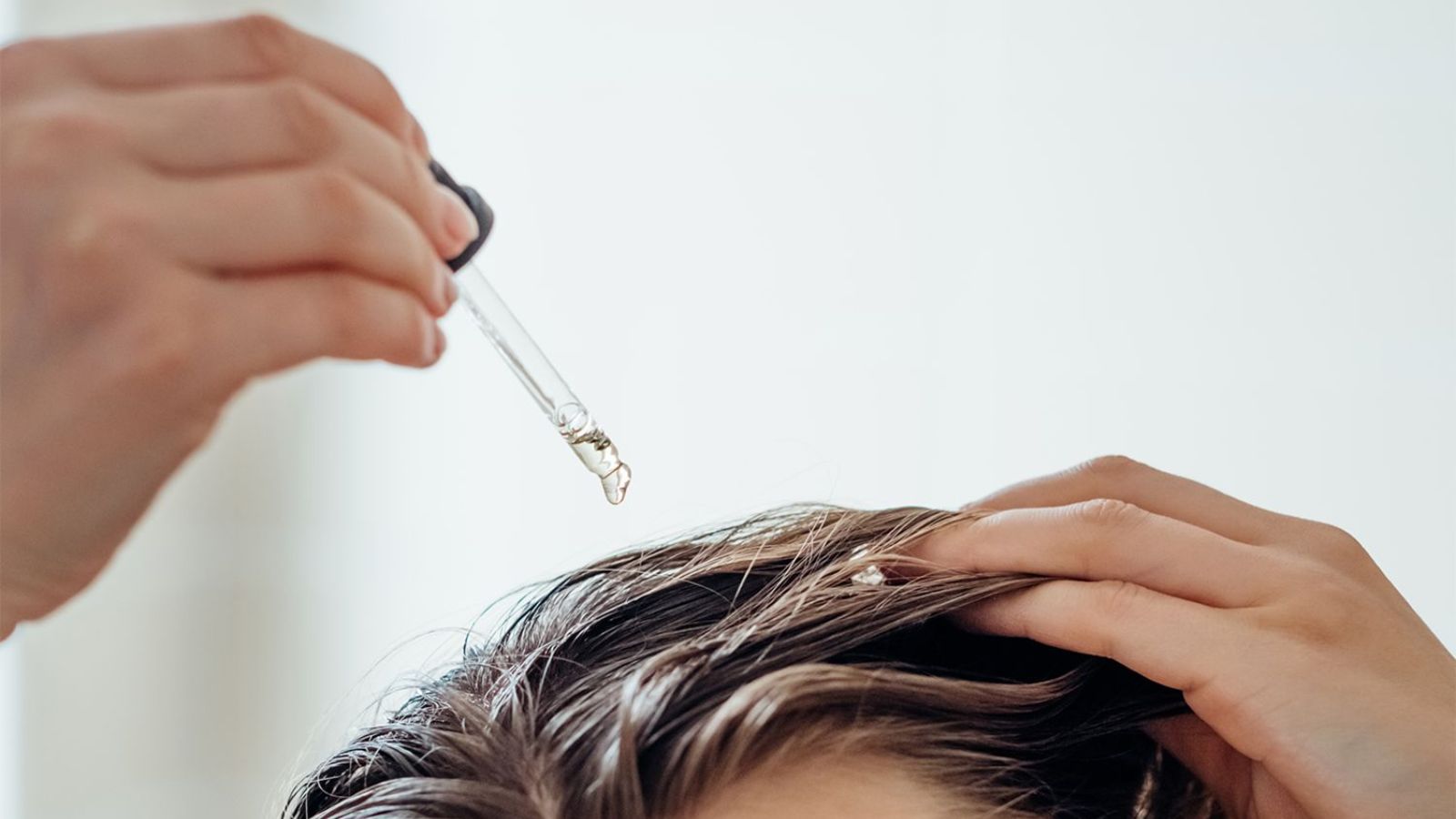 الگوی ریزش مو در مردان